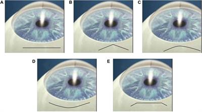 Numerical study of critical straight, frown, and chevron incisions in small incision cataract surgery